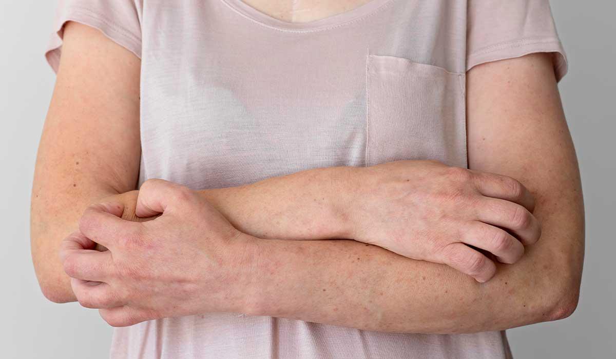 Egzama İçin Beslenme Danışmanlığı